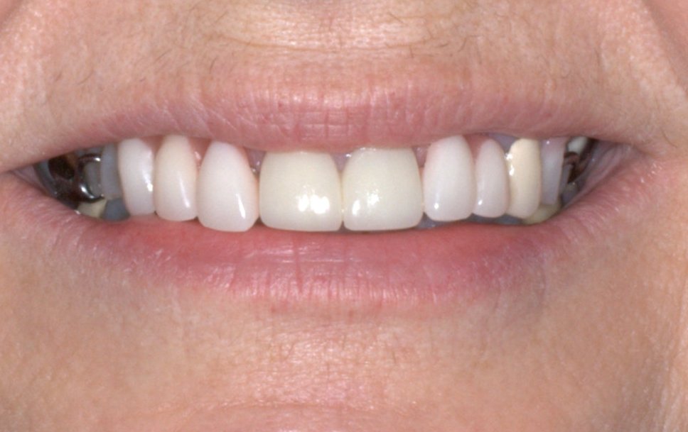 Broken, cracked, and missing teeth can be fixed with restorative dentistry in Edmond.